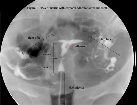 What Is a Hysterosalpingogram?