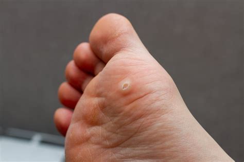 Plantar Warts in Adults & Children — Causes, Treatment, and Prevention ...