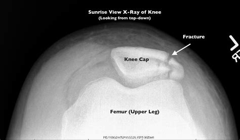 Patella (Knee Cap) Fracture