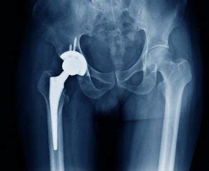 Total Hip Replacement Complications | Types of Hip Replacement