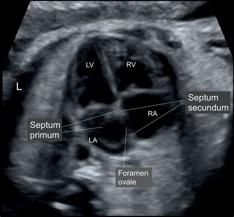 Cardiac Chambers: The Four-Chamber and Short-Axis Views | Obgyn Key | Medical ultrasound ...