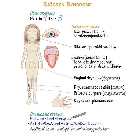 Pathology Glossary: Sjögren Syndrome | Draw It to Know It