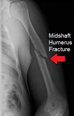 Distal Humerus Avulsion Fracture