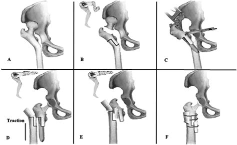 Total hip arthroplasty with step-cut subtrochanteric femoral shortening osteotomy in high riding ...