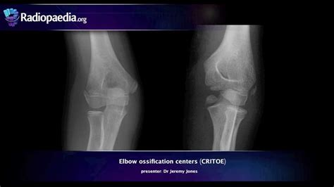 Elbow ossification centers (CRITOE) - radiology video tutorial - YouTube