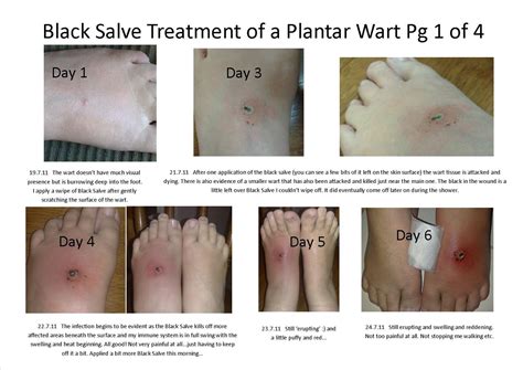 Plantar Wart Causes And Treatment | Gallery Demax