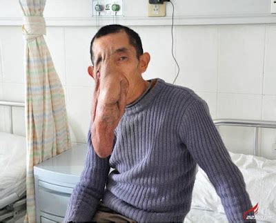 Meet The Man With A Massive Tumor On His Face Like That Of An Elephant (Photos) | OmoMedia - Anuli