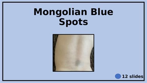 Mongolian Blue Spots - Congenital dermal melanocytosis - Bruises or not? | Teaching Resources