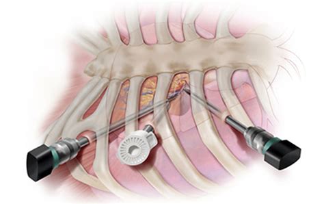 Heart Surgery Types - Open, Bypass, Ablation, Heart Valve surgery