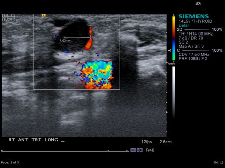 Branchial Cleft Cyst Ultrasound