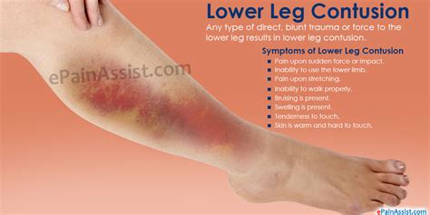 Lower Leg Contusion|Symptoms|Treatment|Stretching, Strengthening Exercises|Sports Massage