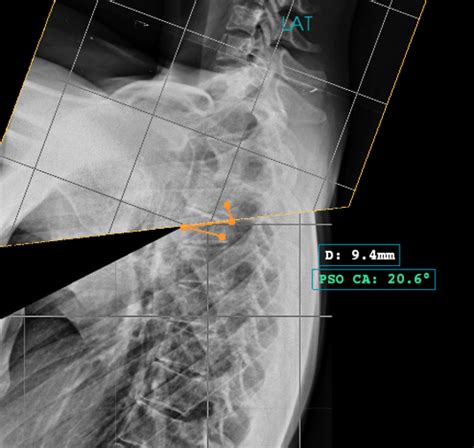 Pedicle Subtraction Osteotomy: How to perform