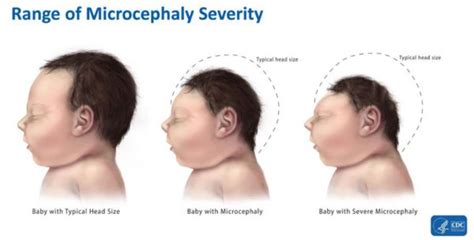 Zika Effects: How to Protect Your Children