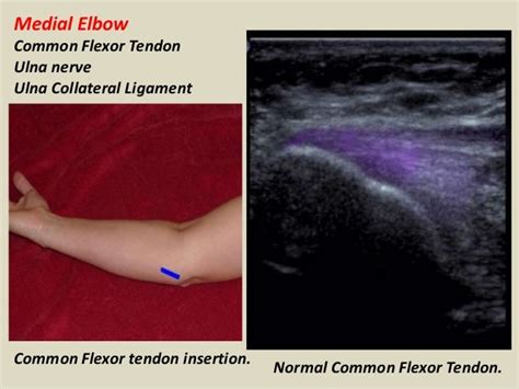 Common Flexor Tendon Elbow Ultrasound