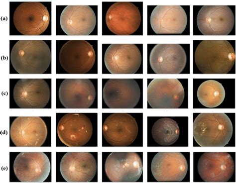 Different stages of Diabetic Retinopathy a) Normal b) Mild c) Moderate ...