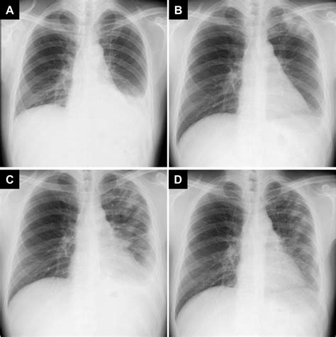 Chest X Ray Consolidation