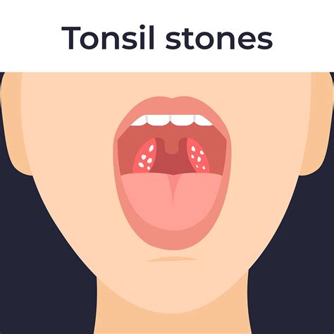 Do You Have Tonsil Stones? Causes, Symptoms & Treatments, With Puyallup,WA Family & General Dentist