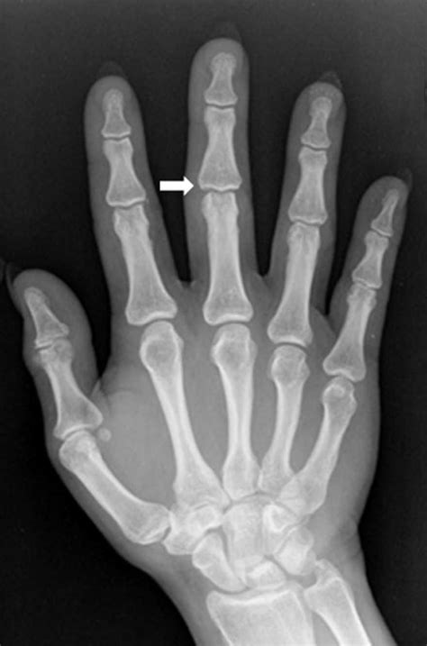 Acute calcific periarthritis in proximal interphalangeal joint: An unusual cause of acute finger ...