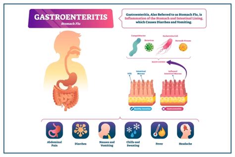 Gastroenteritis Symptoms