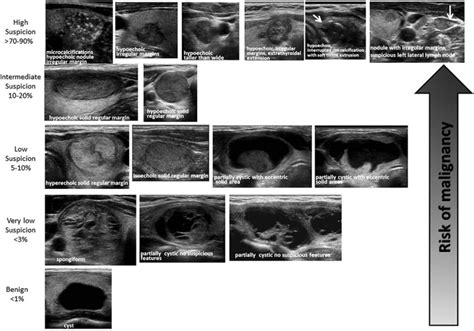 Thyroid Ultrasound – Sonographic Tendencies