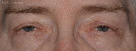 A Primer on Ptosis