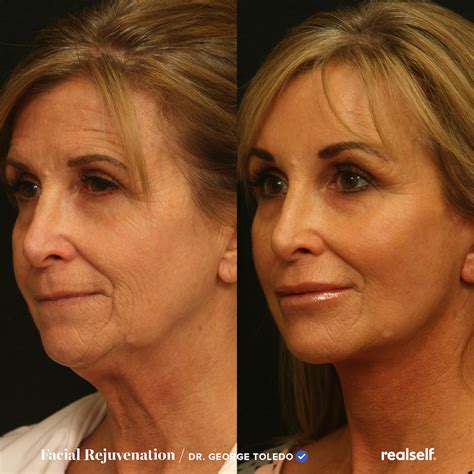 How much does a facelift cost and is it worth it – Artofit