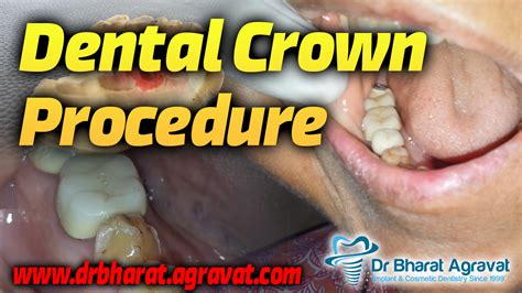 Dental Crown Ahmedabad, Tooth Crown Ahmedabad Dental Clinic IndiaFamous ...