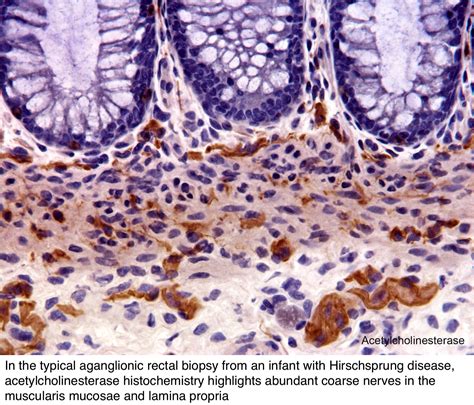 Pathology Outlines - Hirschsprung disease