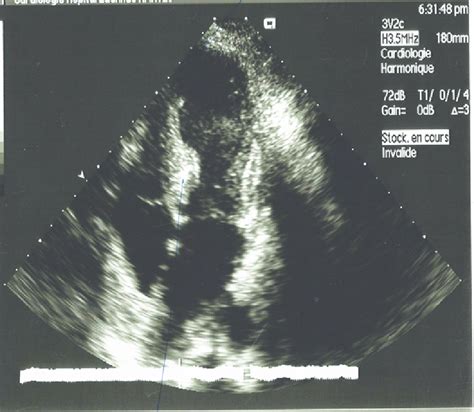 Echocardiography showing hypokinesis of the apex with hyperkinesis of... | Download Scientific ...