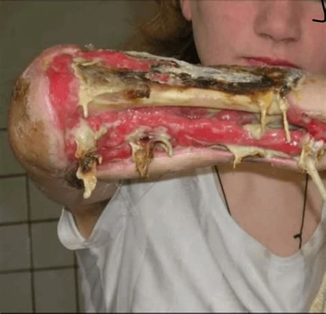 The aftermath of a flesh eating drug “krokodil” - WPD