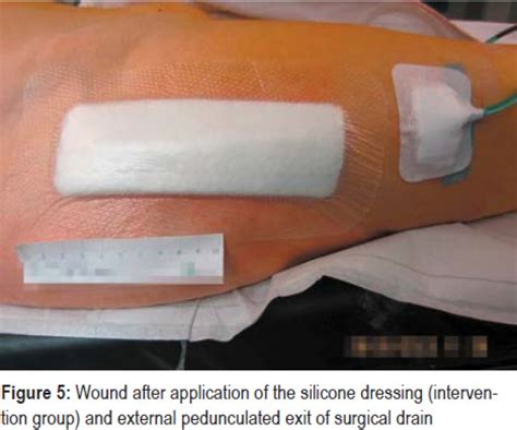 Evaluation of Absorbent Versus Conventional Wound Dressing (30.03.2018)
