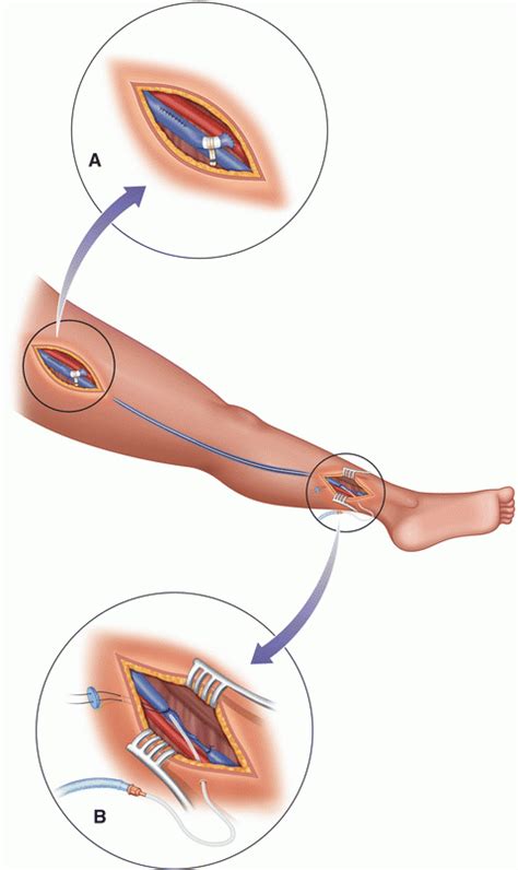 Surgical Thrombectomy for Deep Vein Thrombosis | Thoracic Key