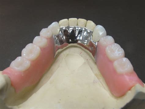 Maxillary Removable Partial Denture