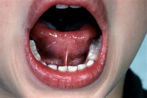 What is tongue tie in babies? - Oris Dental Center