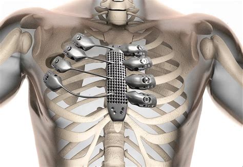 Application of Titanium in Human Implants | Global Sputter Target Supplier