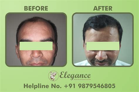 Fue Hair Transplant Results Bharuch, Gujarat, India