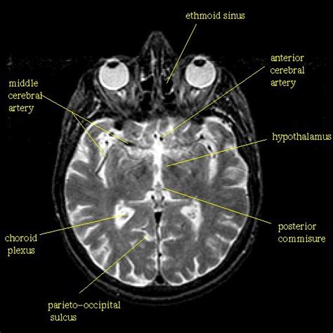 hypothalamus+images | T2-weighted structural MR: Slice 25 | Medical anatomy, Radiology imaging ...