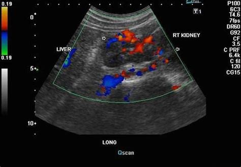 Upper Abdominal & Retroperitoneal Ultrasound | K & T Diagnostic, Inc.