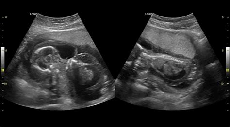 Ultrasound 101(Hydrops fetalis) : r/Radiology