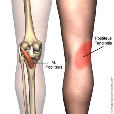 The Popliteus, the Tiny Muscle of Knee Pain!