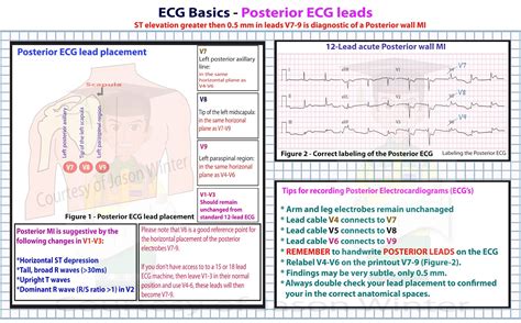 ECG Educator Blog : Posterior ECG Lead Placement