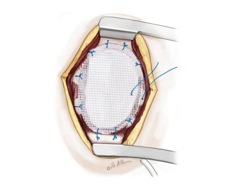 Chest Wall Resection and Reconstruction