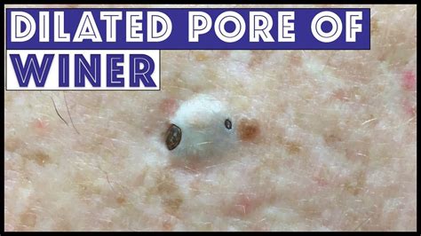 Dilated Pore of Winer Giant Blackhead Satisfying Extractio - Pimplepopping.tv