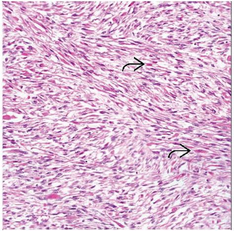 Spindle Cell Rhabdomyosarcoma | Basicmedical Key