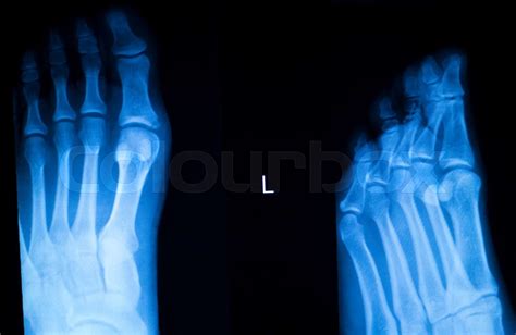 Foot and toes injury x-ray scan | Stock image | Colourbox