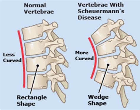 Scheuermann’s Kyphosis - Scoliosis and Spine Associates