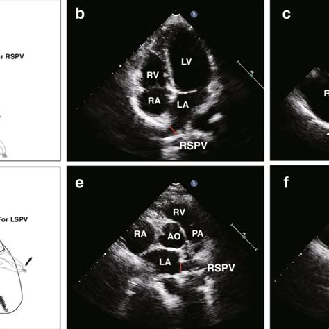 Transthoracic echocardiographic views (a and d) to detect and measure... | Download Scientific ...