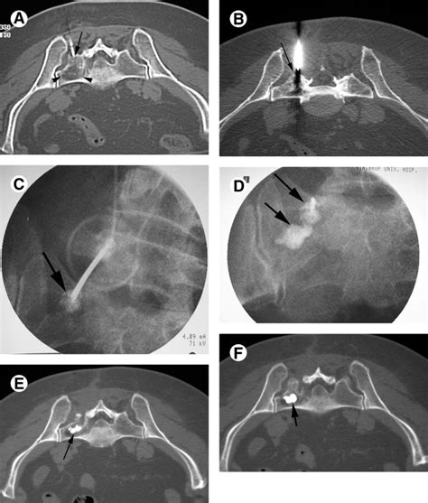 Sacroplasty - Techniques in Vascular & Interventional Radiology