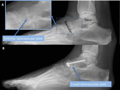 Talonavicular Arthitis | Arthritis Of The Talonavicular Joint