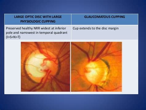 Optic disc evaluation